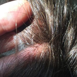 forum protesi capelli