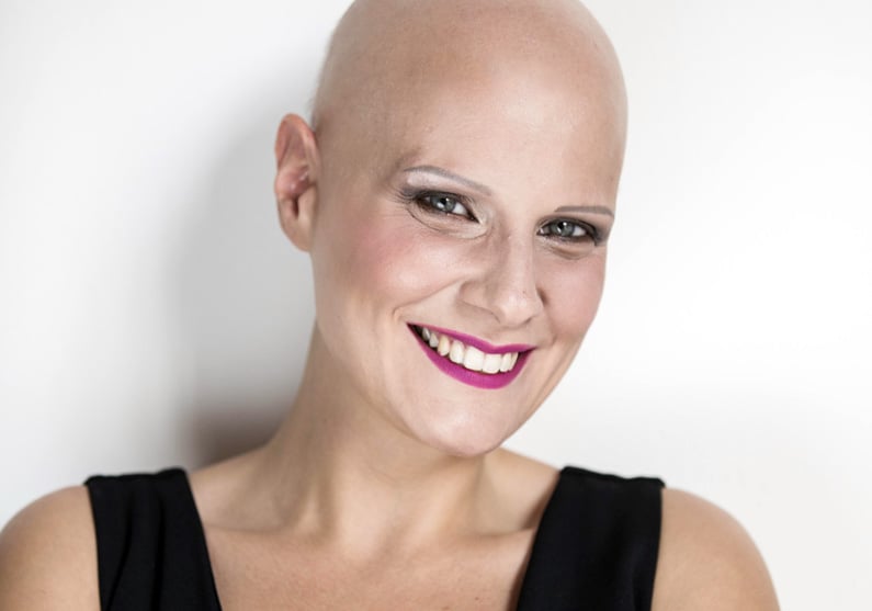 alopecia